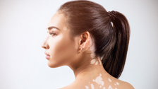 Vitiligo izbliza: Sve što treba da znate o stanju koje može uticati na život