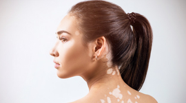 Vitiligo izbliza: Sve što treba da znate o stanju koje može uticati na život